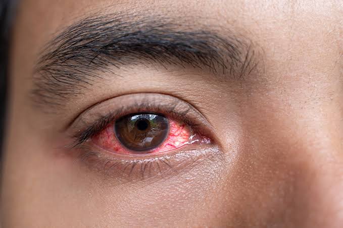 Be cautious, authorities warns as red eye disease spreads