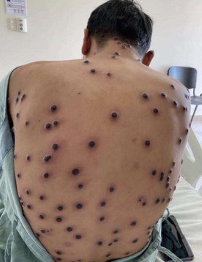 Second Case of Mpox Variant Confirmed in Thailand